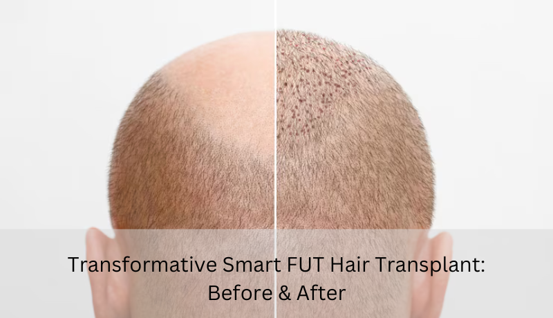 Transformative Smart FUT Hair Transplant: Before & After