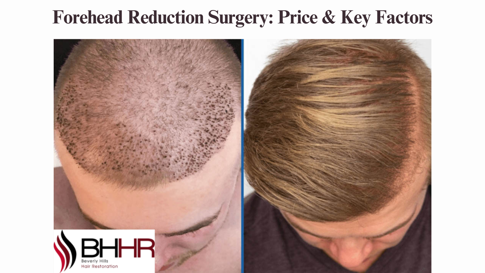 Forehead Reduction Surgery: Price & Key Factors